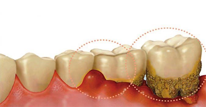 Viêm Lợi Phì Đại - Khi Nụ Cười Bị Che Khuất Bởi Nướu Sưng