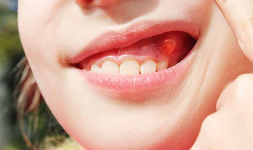 Viêm Lợi Phì Đại - Khi Nụ Cười Bị Che Khuất Bởi Nướu Sưng