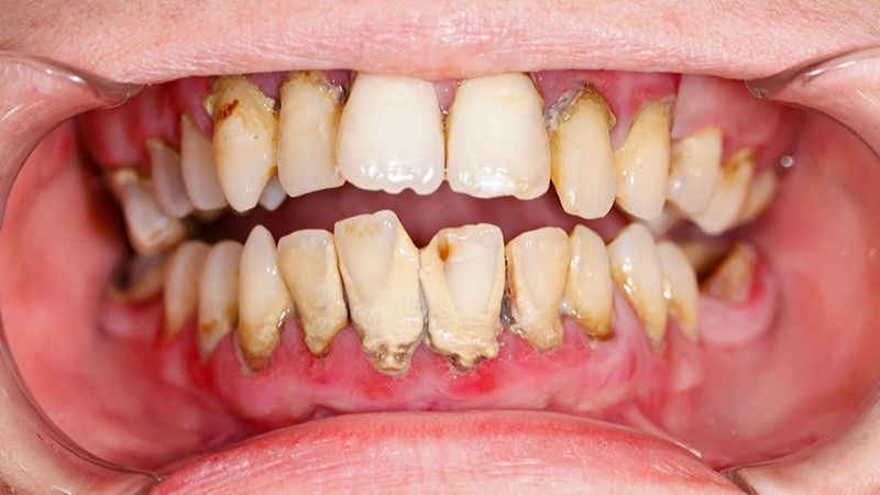 Viêm Lợi Phì Đại - Khi Nụ Cười Bị Che Khuất Bởi Nướu Sưng