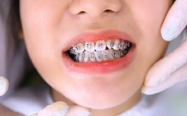 Bọc sứ có niềng răng được không?