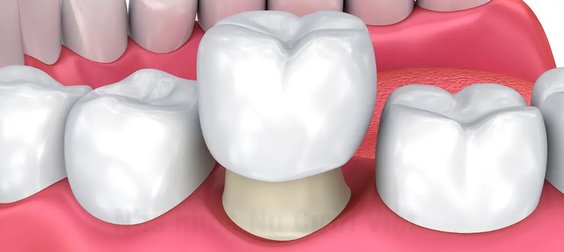 Bọc sứ có niềng răng được không?
