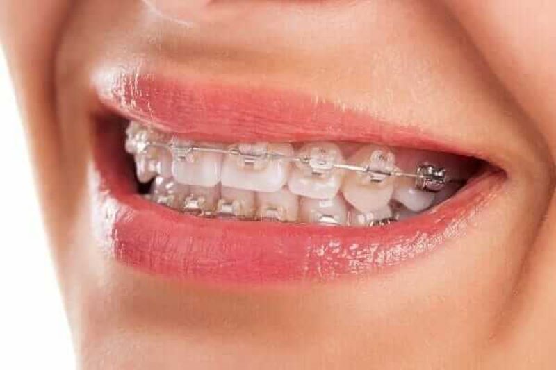 Bọc sứ có niềng răng được không?