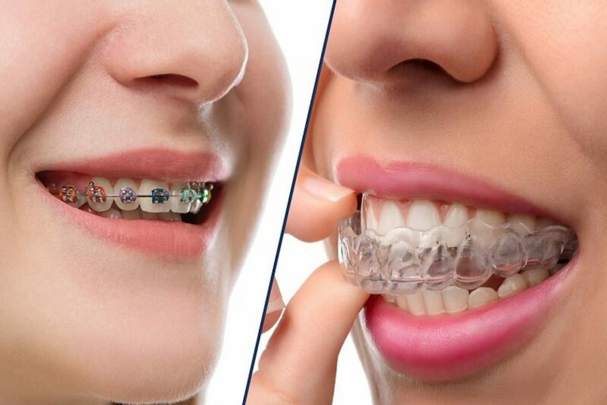 Bọc sứ có niềng răng được không?