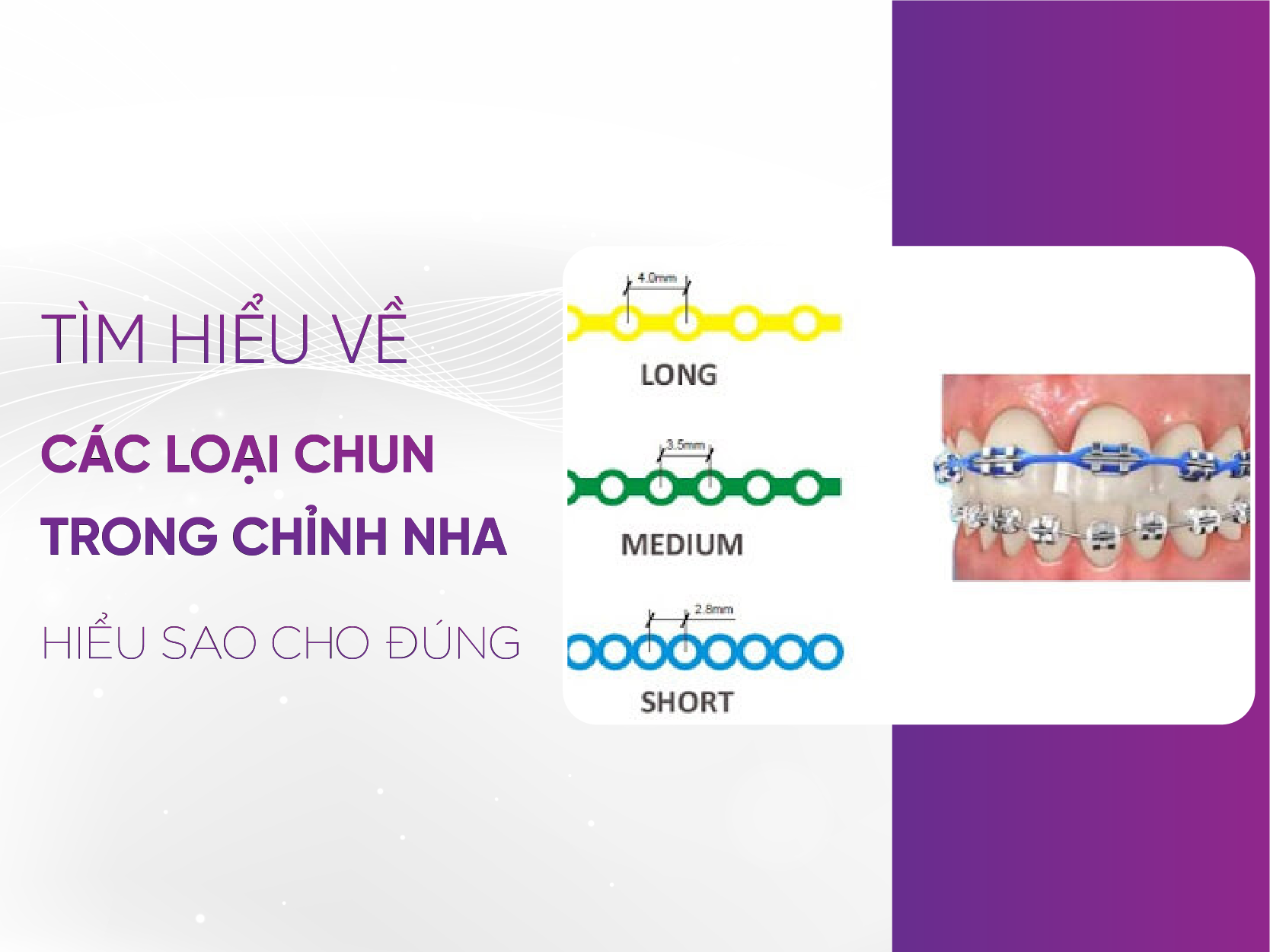 Chun Chỉnh Nha Là Gì Và So Sánh Các Loại Chun Chỉnh Nha