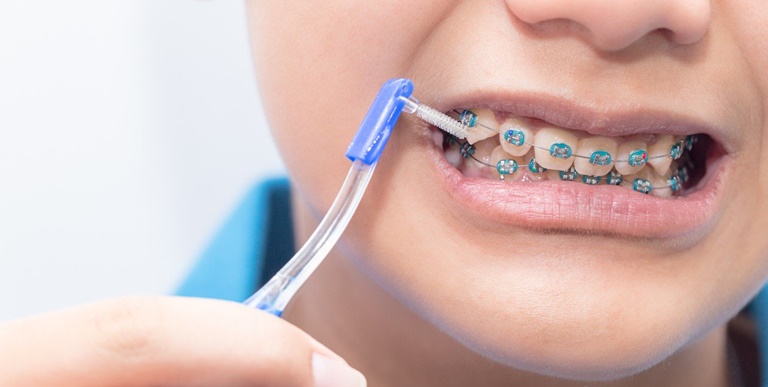 Chun chỉnh nha - Kiến tạo nụ cười hoàn hảo từ nền tảng vững chắc