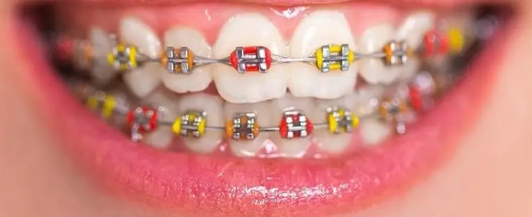 Chun chỉnh nha - Kiến tạo nụ cười hoàn hảo từ nền tảng vững chắc