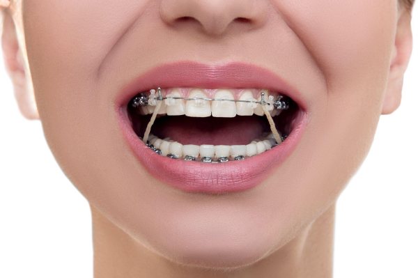Chun chỉnh nha - Kiến tạo nụ cười hoàn hảo từ nền tảng vững chắc