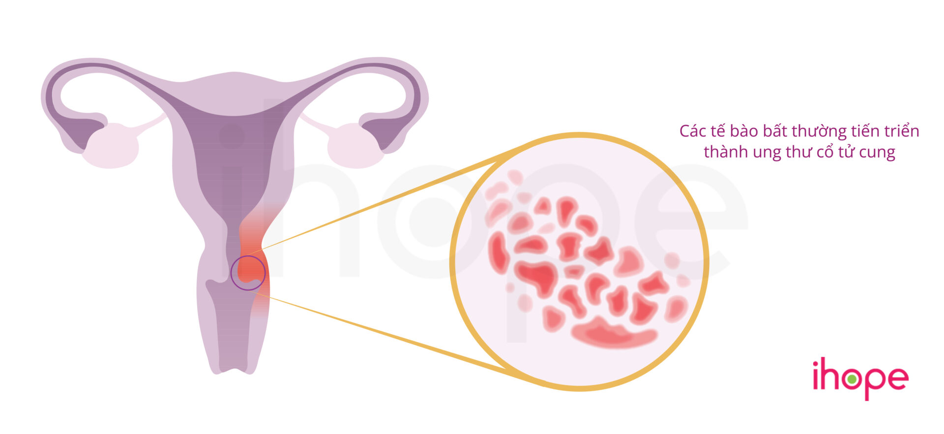 HPV lây qua đường nào - Chìa khóa hiểu rõ và bảo vệ bản thân