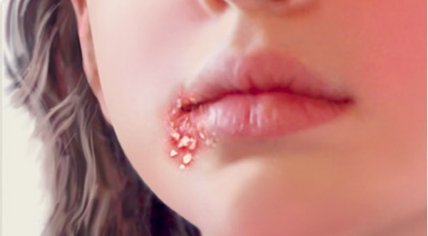 HPV lây qua đường nào - Chìa khóa hiểu rõ và bảo vệ bản thân