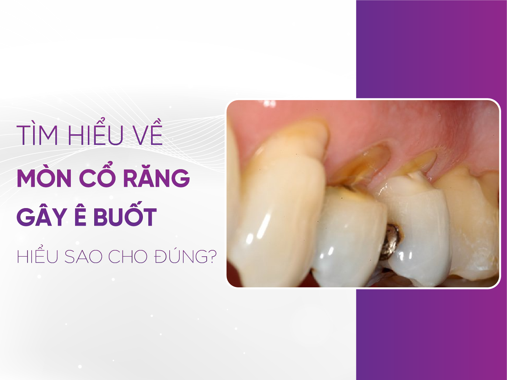 Mòn Răng Gây Ê Buốt - Mối Lo Thầm Lặng Và Giải Pháp Điều Trị
