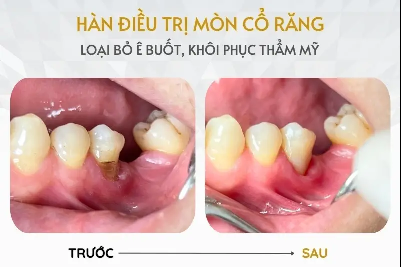 Mòn răng gây ê buốt - Mối lo thầm lặng và giải pháp toàn diện cho nụ cười