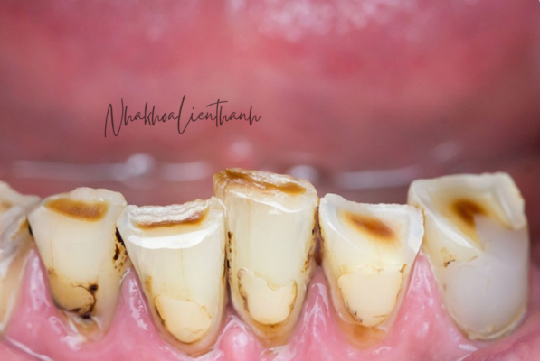 Mòn răng gây ê buốt - Mối lo thầm lặng và giải pháp toàn diện cho nụ cười