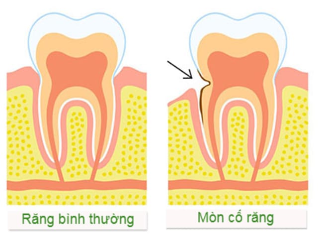 Mòn răng gây ê buốt - Mối lo thầm lặng và giải pháp toàn diện cho nụ cười