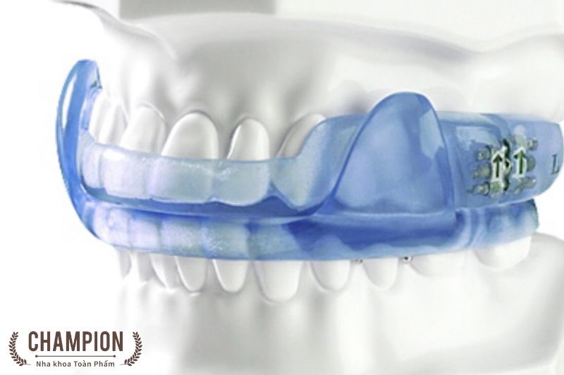 Nghiến răng do đâu? Nguyên nhân và cách khắc phục hiệu quả