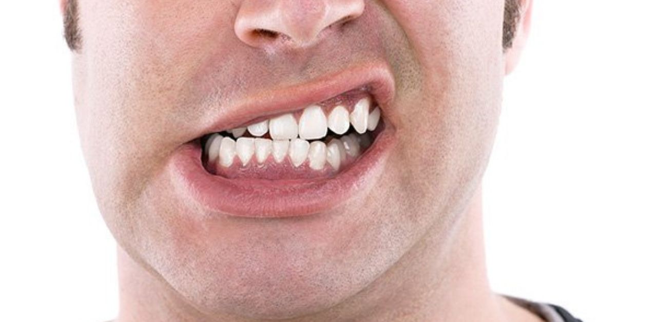 Nghiến răng do đâu? Nguyên nhân và cách khắc phục hiệu quả