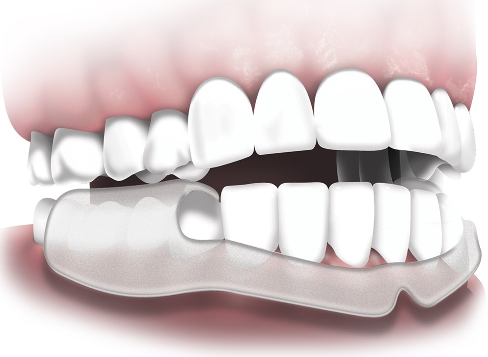 Nghiến răng do đâu? Nguyên nhân và cách khắc phục hiệu quả