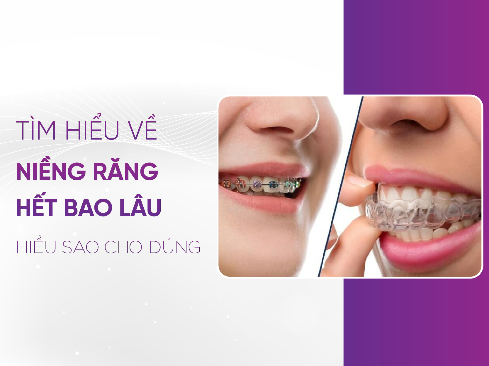 Niềng Răng Mất Bao Lâu? Những Yếu Tố Ảnh Hưởng Đến Thời Gian