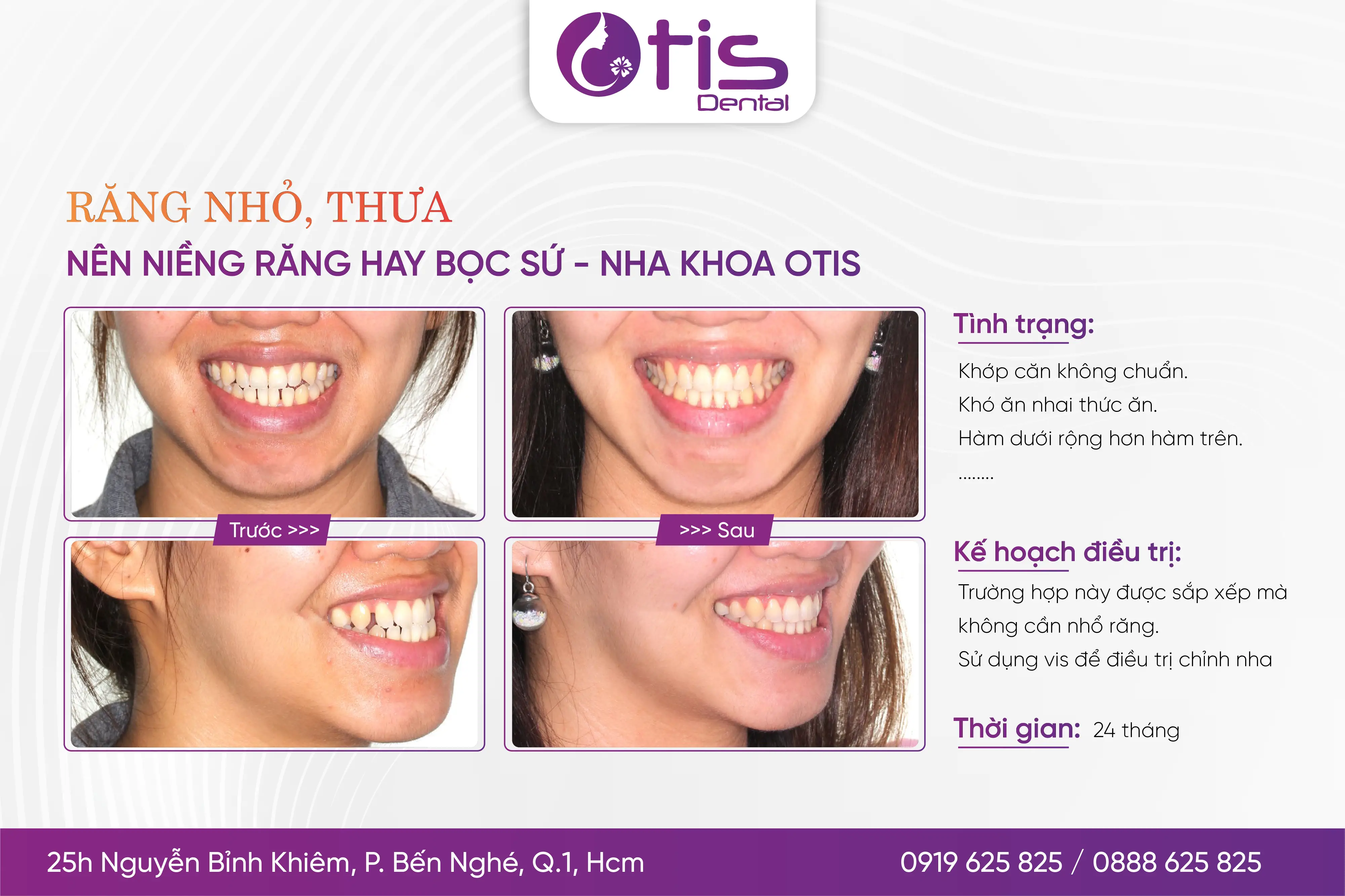 Niềng răng mất bao lâu? Những yếu tố ảnh hưởng đến thời gian Niềng Răng Mất Bao Lâu? Những Yếu Tố Ảnh Hưởng Đến Thời Gian