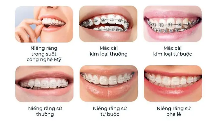 Niềng răng mất bao lâu? Thời gian điều trị và những yếu tố ảnh hưởng Niềng Răng Mất Bao Lâu? Thời Gian Điều Trị Và Những Yếu Tố Ảnh Hưởng