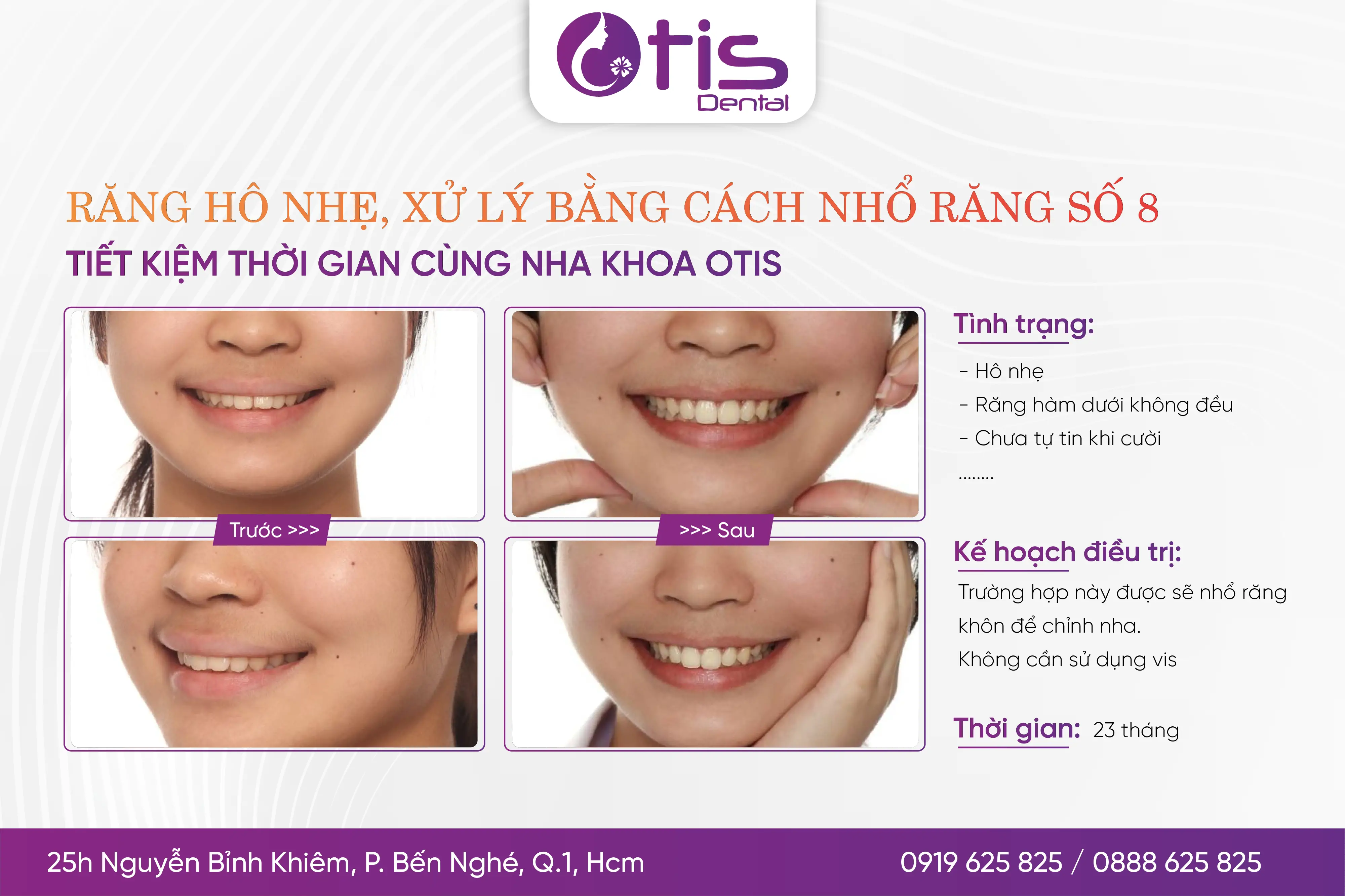 Niềng răng mất bao lâu? Những yếu tố ảnh hưởng đến thời gian Niềng Răng Mất Bao Lâu? Những Yếu Tố Ảnh Hưởng Đến Thời Gian