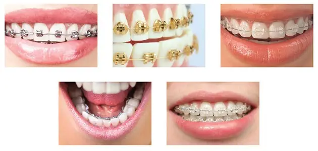 Niềng răng mất bao lâu? Thời gian điều trị và những yếu tố ảnh hưởng Niềng Răng Mất Bao Lâu? Thời Gian Điều Trị Và Những Yếu Tố Ảnh Hưởng