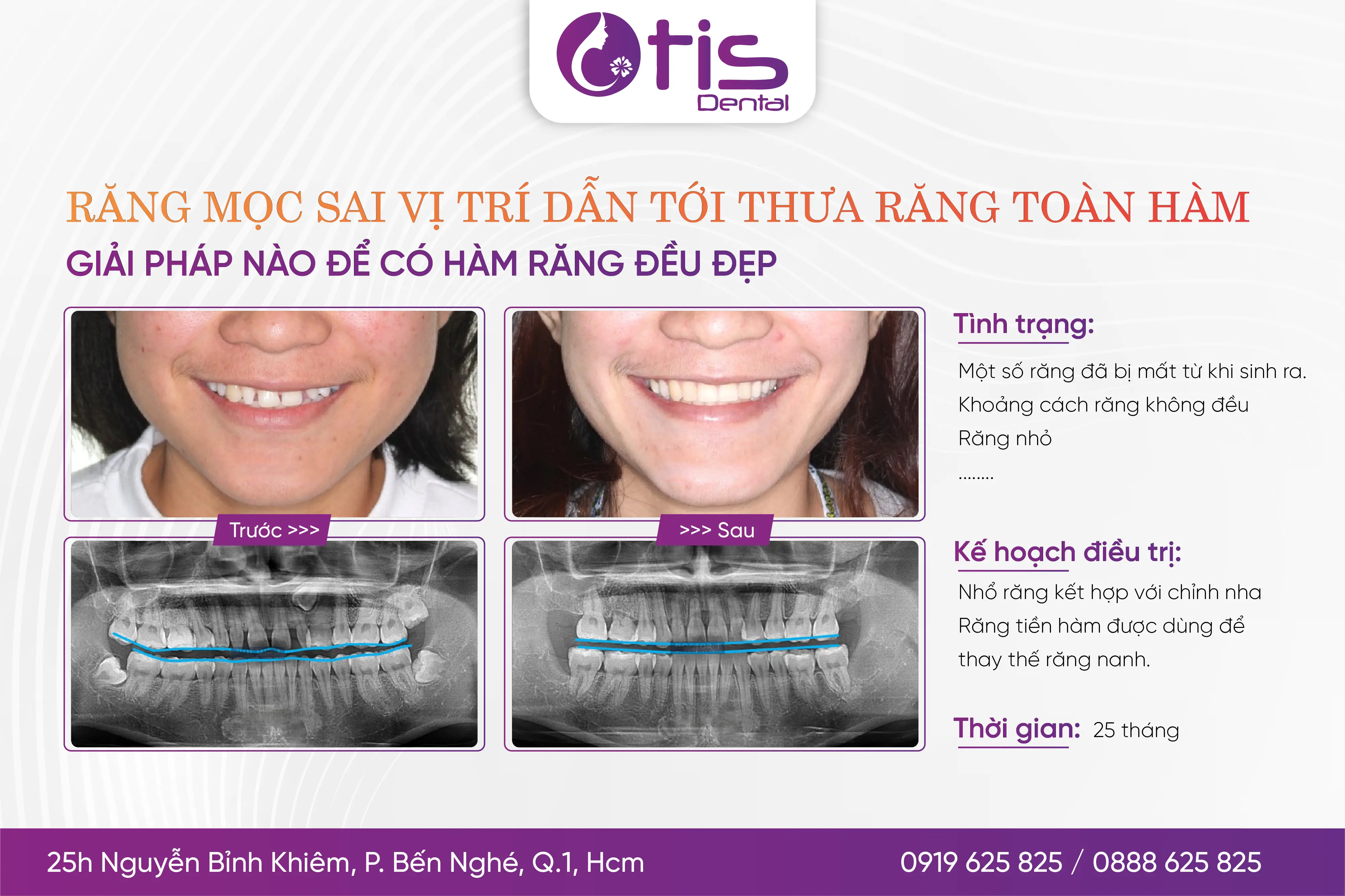 Niềng răng mất bao lâu? Những yếu tố ảnh hưởng đến thời gian Niềng Răng Mất Bao Lâu? Những Yếu Tố Ảnh Hưởng Đến Thời Gian