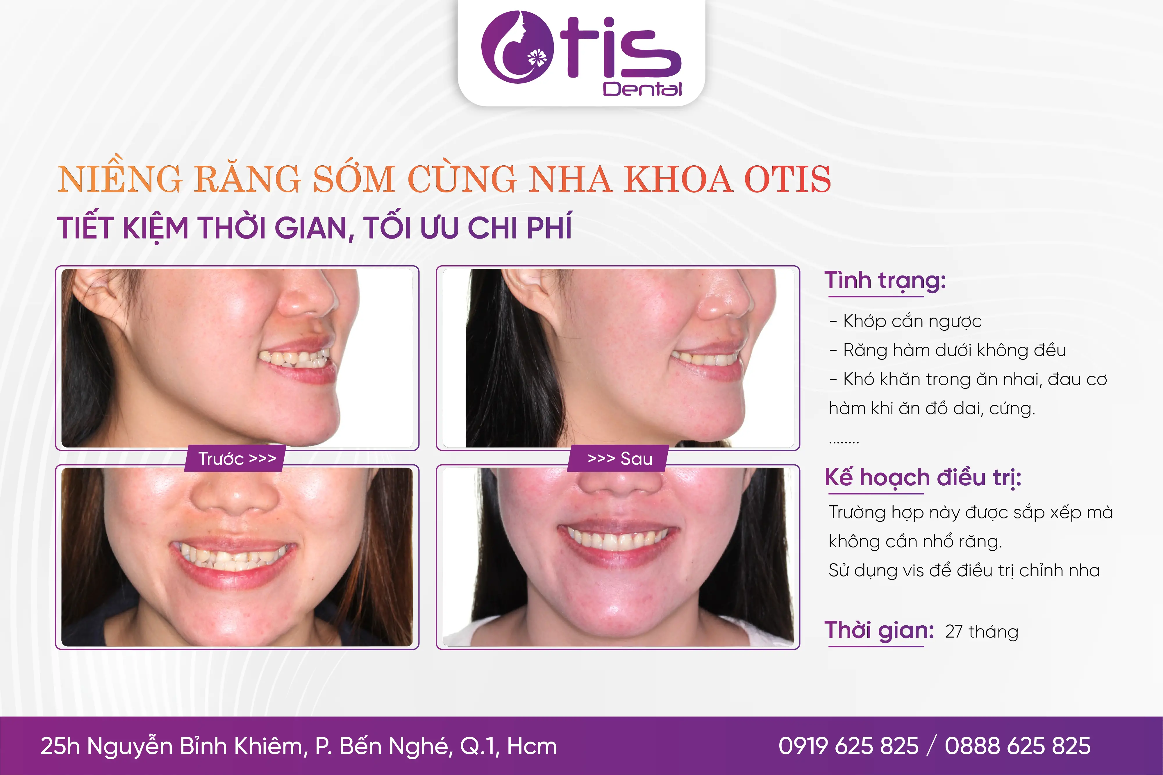 Niềng răng mất bao lâu? Những yếu tố ảnh hưởng đến thời gian Niềng Răng Mất Bao Lâu? Những Yếu Tố Ảnh Hưởng Đến Thời Gian