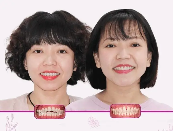 Phụ nữ mang thai niềng răng - Cân nhắc toàn diện cho mẹ và bé an toàn