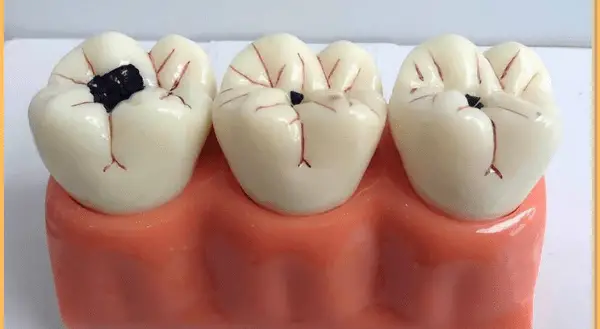 Sâu răng có bị lây không? Sự thật bạn cần biết để bảo vệ răng miệng Sâu Răng Có Bị Lây Không? Sự Thật Bạn Cần Biết Để Bảo Vệ Răng Miệng