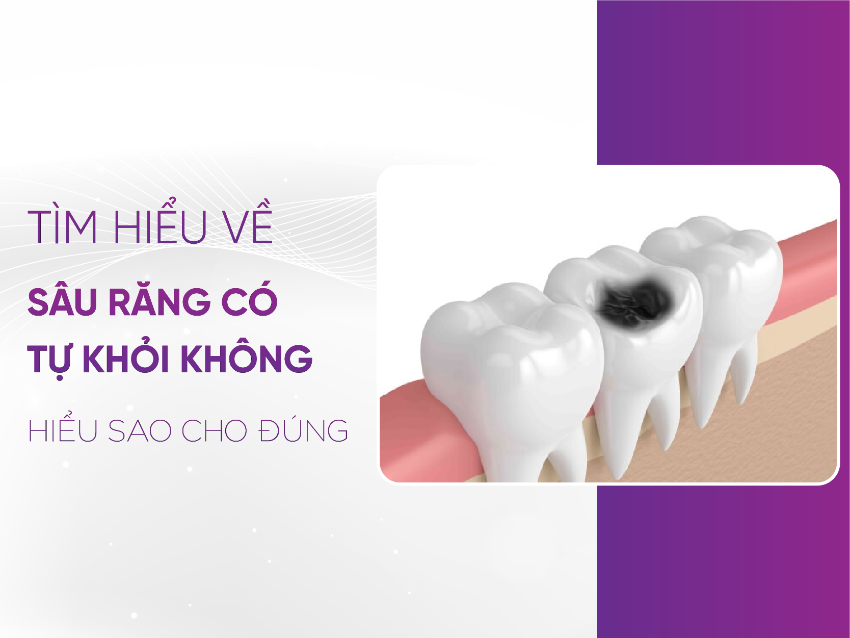 Sâu Răng Có Tự Hết Không? Sự Thật Không Nên Bỏ Qua