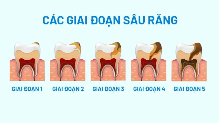 Sâu răng có tự hết không? Sự thật không nên bỏ qua Sâu Răng Có Tự Hết Không? Sự Thật Không Nên Bỏ Qua