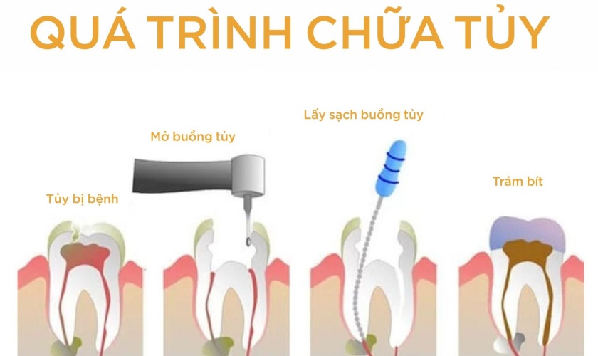 Sâu răng có tự hết không? Sự thật không nên bỏ qua Sâu Răng Có Tự Hết Không? Sự Thật Không Nên Bỏ Qua