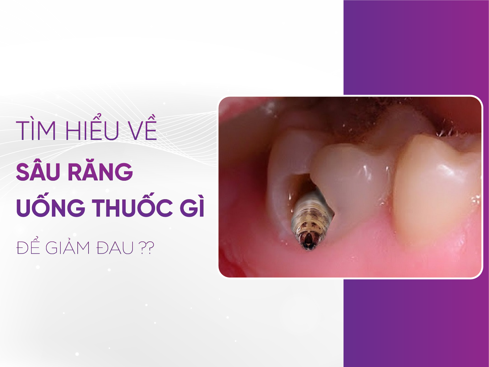 Sâu Răng Uống Thuốc Gì? Hướng Dẫn Hiệu Quả Để Giảm Đau