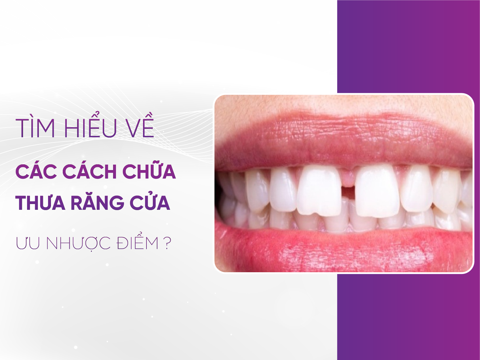 Sửa Răng Cửa Bị Thưa Có Mấy Cách Và Ưu Nhược Điểm