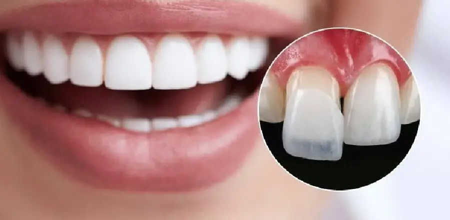 Sửa Răng Cửa Bị Thưa Có Mấy Cách Và Ưu Nhược Điểm