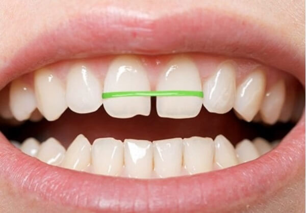 Sửa Răng Cửa Bị Thưa Có Mấy Cách Và Ưu Nhược Điểm