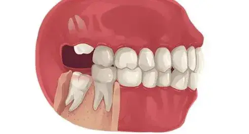 15 tuổi mọc răng khôn có sao không? 15 Tuổi Mọc Răng Khôn Có Sao Không - Giải Đáp Toàn Diện Và Lời Khuyên Từ Chuyên Gia
