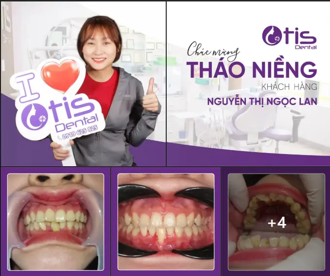 19 tuổi niềng răng được không ?
