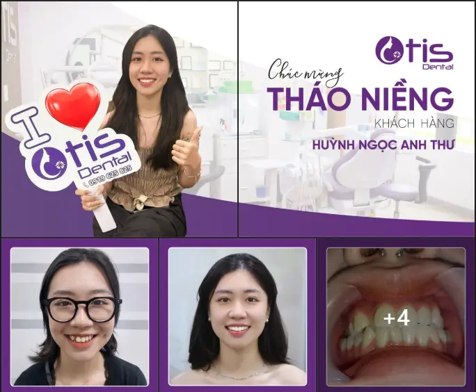 19 tuổi niềng răng được không ?