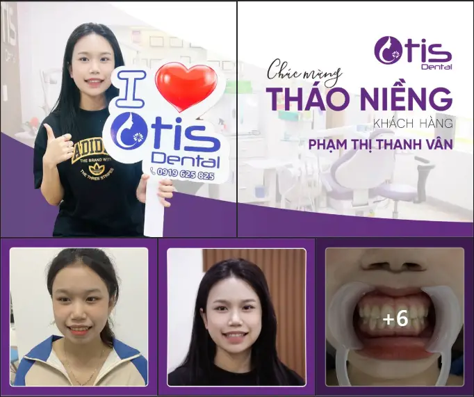 19 tuổi niềng răng được không ?
