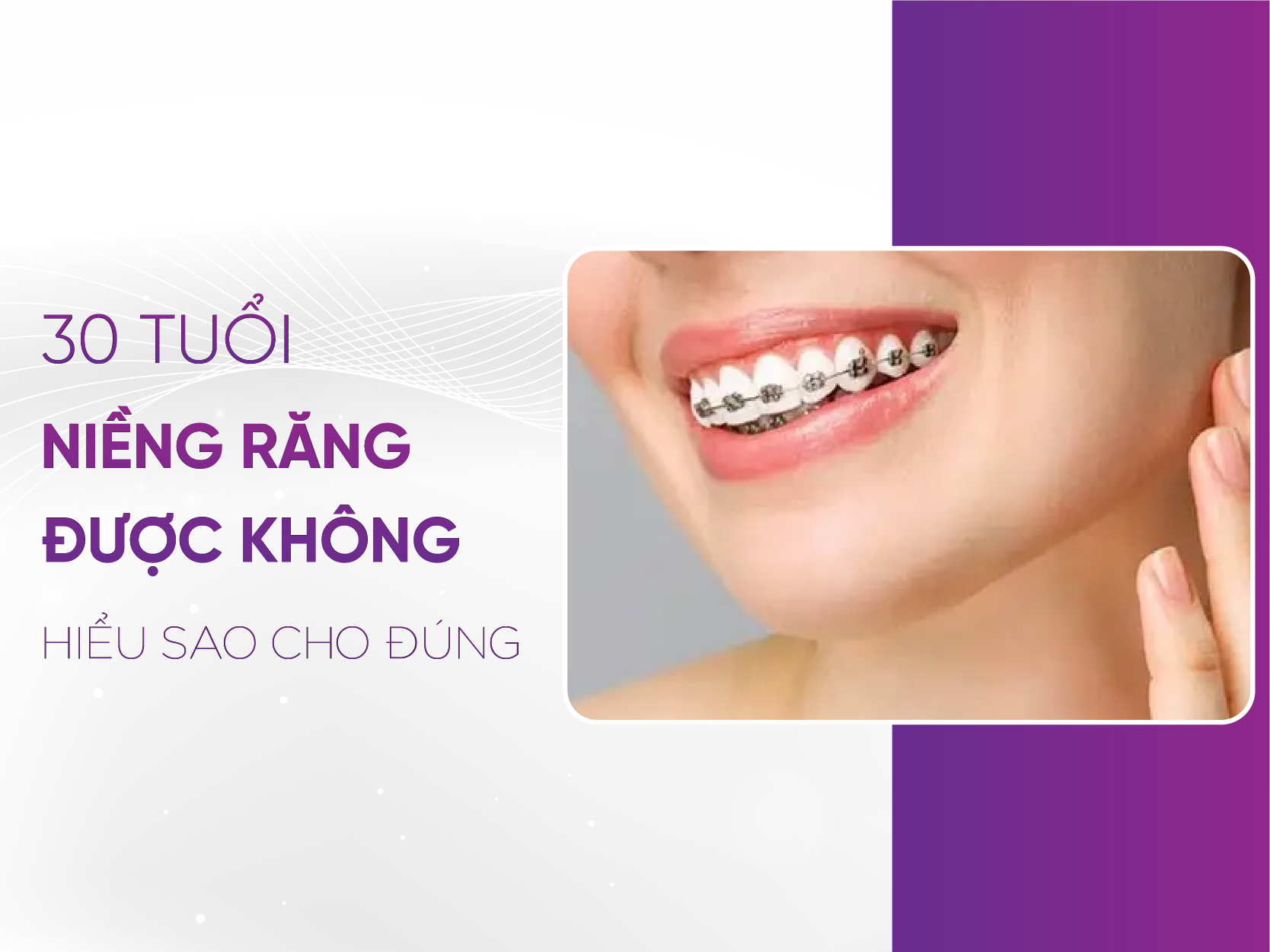 30 Tuổi Niềng Răng Được Không? Lưu Ý Của Bác Sĩ