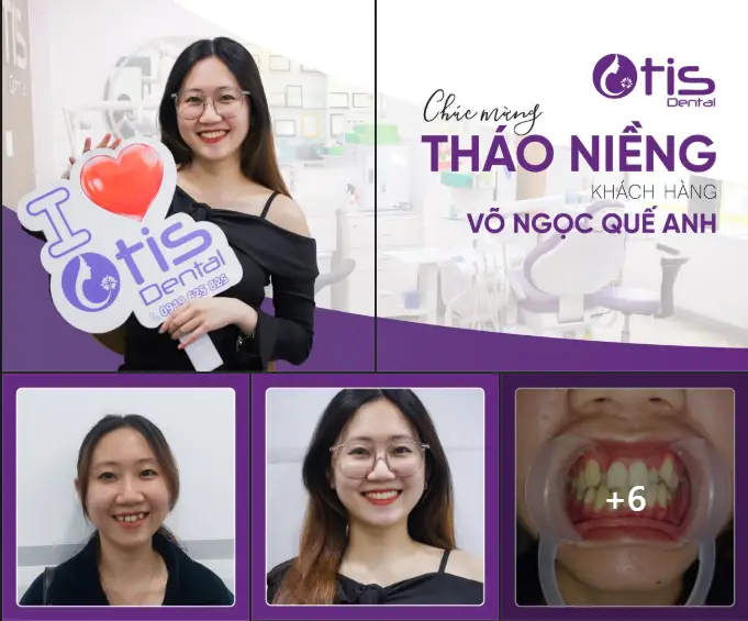 30 tuổi niềng răng được không? Lưu ý của bác sĩ