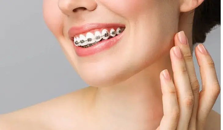 30 tuổi niềng răng được không? Lợi ích và lưu ý khi niềng răng ở người trưởng thành