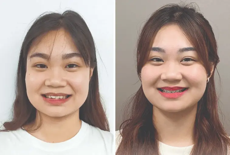 30 tuổi niềng răng được không? Lợi ích và lưu ý khi niềng răng ở người trưởng thành
