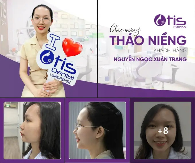 30 tuổi niềng răng được không? Lưu ý của bác sĩ