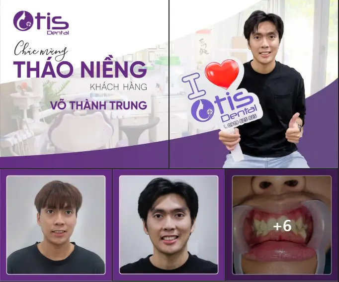 30 tuổi niềng răng được không? Lưu ý của bác sĩ