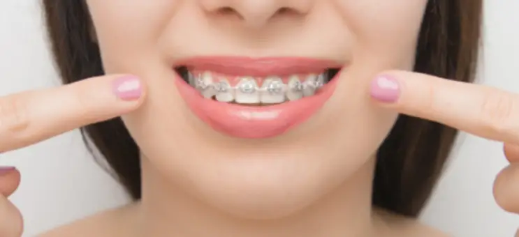 30 tuổi niềng răng được không? Lợi ích và lưu ý khi niềng răng ở người trưởng thành