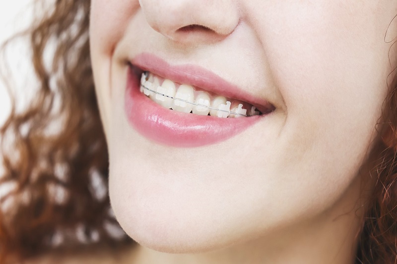 30 tuổi niềng răng được không? Lợi ích và lưu ý khi niềng răng ở người trưởng thành