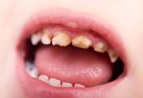 Trẻ thay răng sớm có tốt hay không?