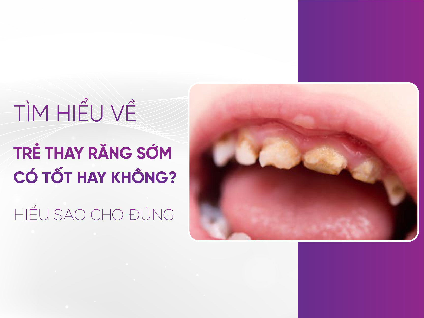 Bé 5 Tuổi Thay Răng Có Sớm Không?